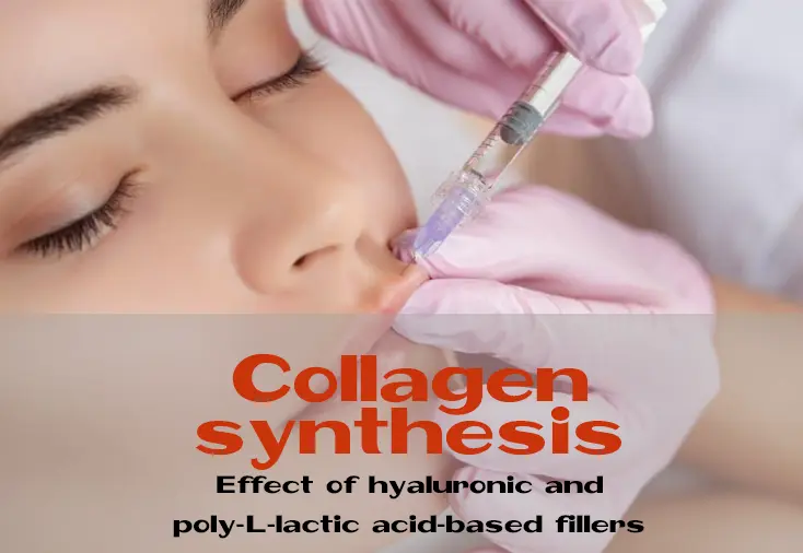 The widespread use of fillers in modern cosmetology makes it necessary to thoroughly understand the processes occurring in the skin during their introduction: only then will the result be predictable and the procedure will be safe for patients. Here is the result of comparative in vitro and in vivo studies of the effect of two types of fillers: hyaluronic and poly-L-lactic acid based
