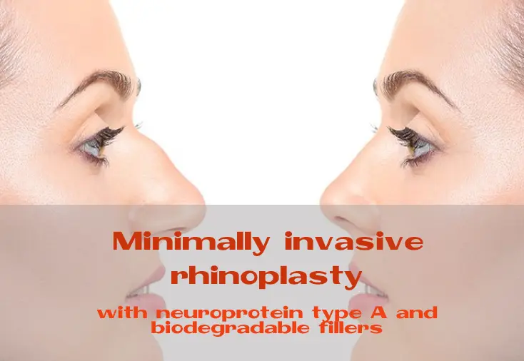The authors of this article have developed an original minimally invasive approach to its correction, which you can use as an alternative to surgical rhinoplasty.