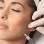 Mesotherapy (4 videos)- short course