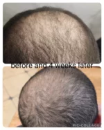 Atlantis Hair Exosomes 5 ml x 10 vials - Image 3