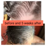 Atlantis Hair Exosomes 5 ml x 10 vials - Image 4